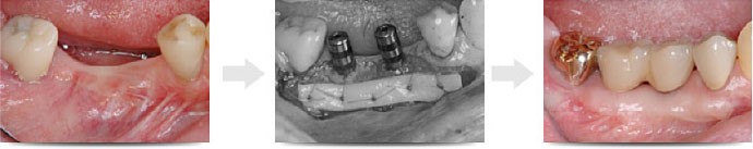 歯肉移植手術：見た目を回復する